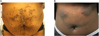 Extracellular matrix and dermal nerve growth factor dysregulation in prurigo nodularis compared to atopic dermatitis